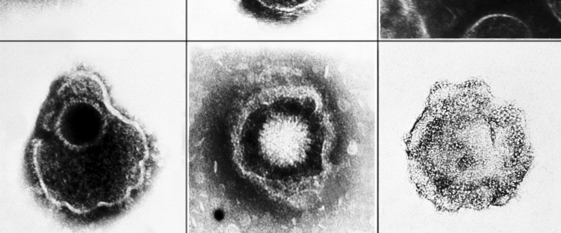 Why Herpes is Not Included in STD Tests